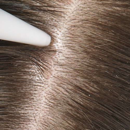 العناية بفروة الرأس