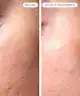 Qure Skincare - Micro-Infusion System 3 Month Supply Hydra-Soothing + Rejuvenating