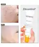 Acnemy - Zitcontrol® Treatment