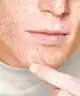 Acnemy - Zitless® Microdart Patches
