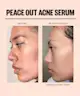 Peace Out - Acne Champions Kit