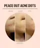 Peace Out - Acne Champions Kit