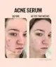 Peace Out - Acne Serum