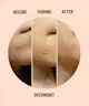 Peace Out - Acne Healing Dots Jumbo