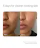 Solawave - Bye Acne Light Therapy Spot Treatment