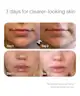 Solawave - Bye Acne Light Therapy Spot Treatment